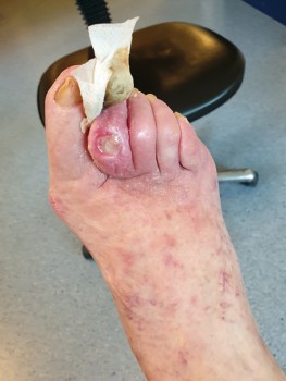 De rechtervoet van mevrouw Jansen