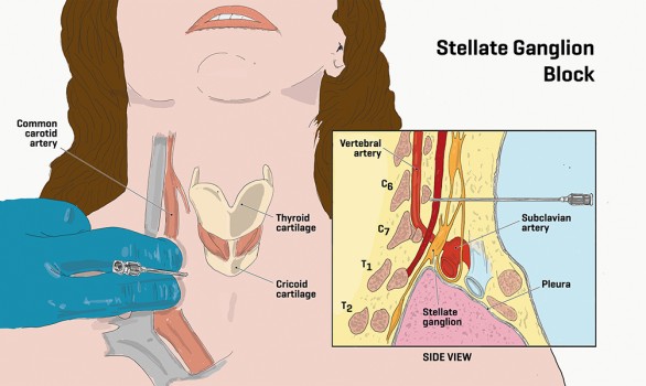 Ganglion stellatum-blokkade