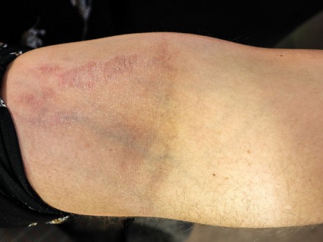 Striae op de elleboog als uiting van dermatocorticosteroïdgeinduceerde cutane atrofie