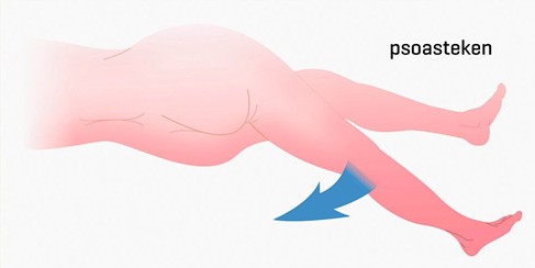 Testen van het psoasfenomeen (psoasteken)