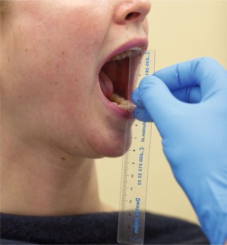 Meten van de maximale mondopening met een liniaal