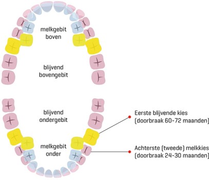 Kaasmolaren in het melkgebit (HSPM) en in het blijvende gebit (MIH)