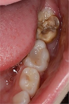 De eerste blijvende molaar linksonder vertoont de geelbruine verkleuring, typerend voor kaasmolaren. Daarnaast is te zien dat bij deze kies ook stukken glazuur zijn afgebroken. De tweede melkmolaar heeft een grote restauratie, die niet past bij het cariëspatroon van dit kind. Ook deze molaar kan gezien worden als een kaasmolaar
