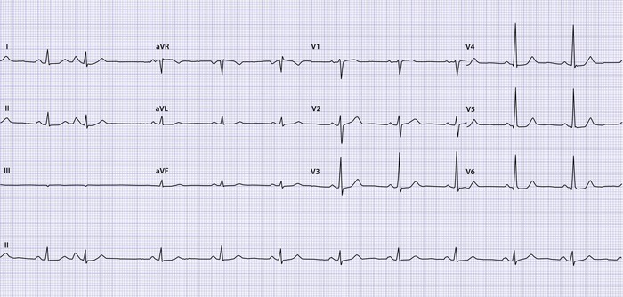 Ecg A