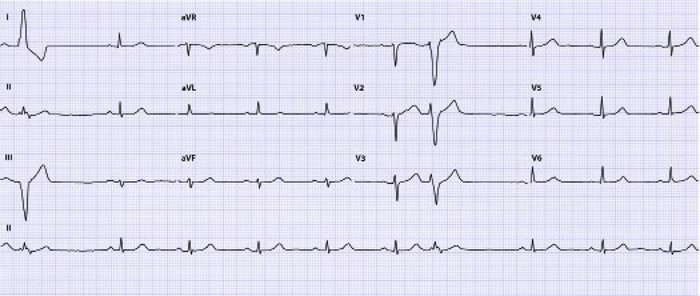 Ecg B