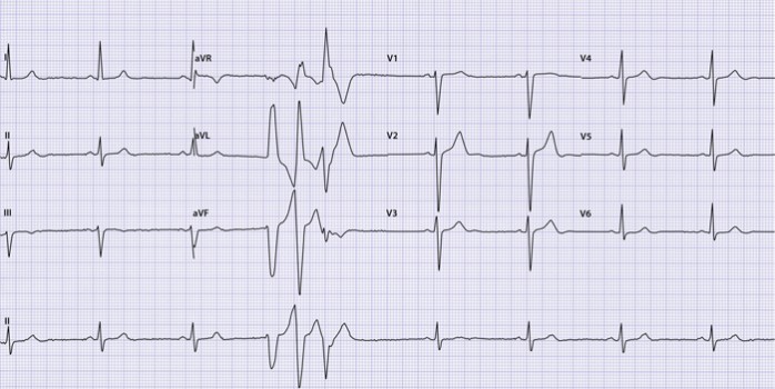 Ecg C