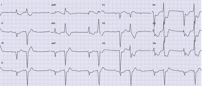 Ecg 2