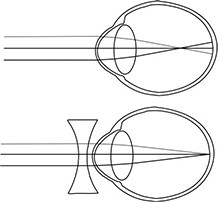 Myopie moet worden gecorrigeerd door een bril of contactlens.