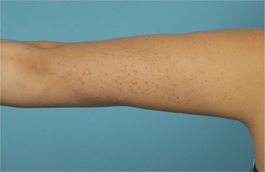 Arm van een meisje met gianotti-crostisyndroom