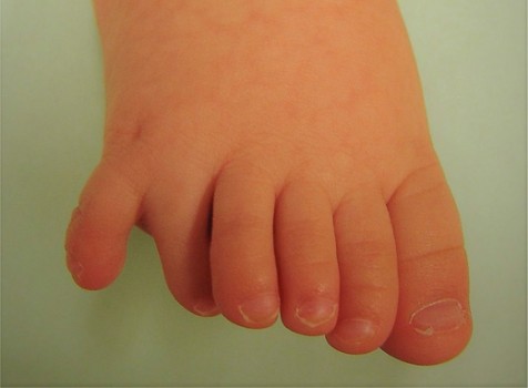 Rechtervoet met een extra teentje