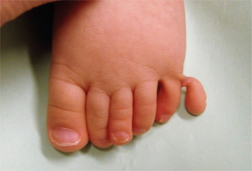 Linkervoet met aanhangend stuk weefsel (waar soms wel, soms geen botjes in zitten)