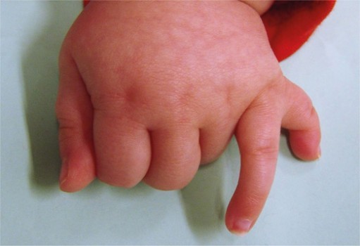 Postaxiale polydactylie: extra vinger aan de pinkzijde