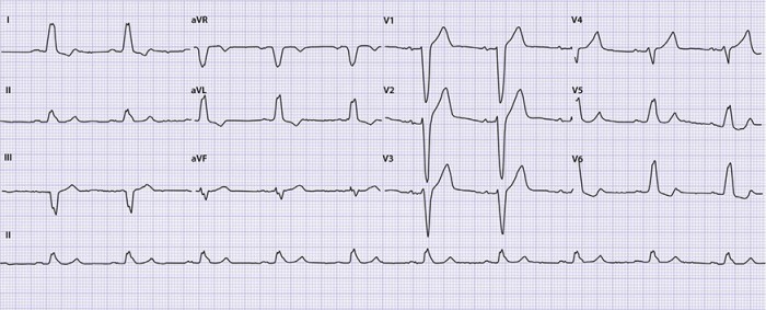 Recent ecg