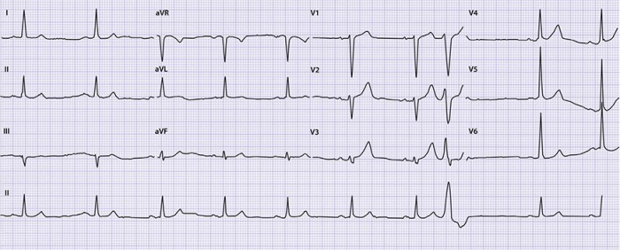 Ecg van 10 maanden eerder