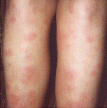 Erythema nodosum
