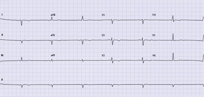 ecg-casus