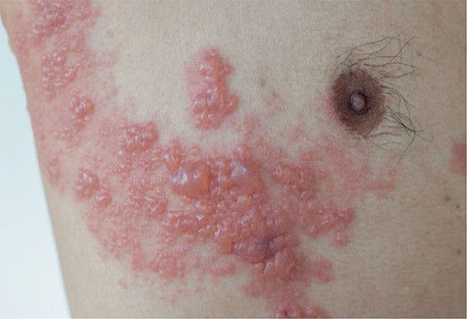 Het huidige vaccin tegen gordelroos bevat een verzwakt levens virus dat onvoldoende effectief is.