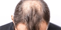 Alopecia androgenetica