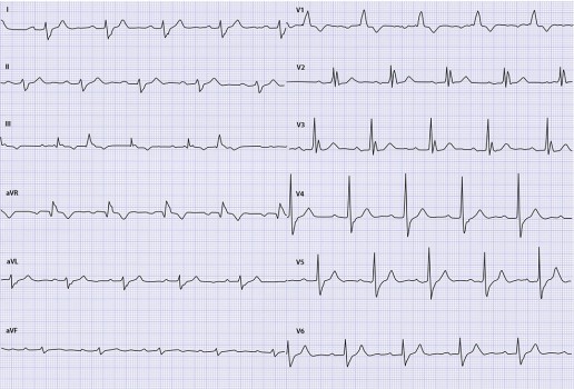 ECG Acuut probleem