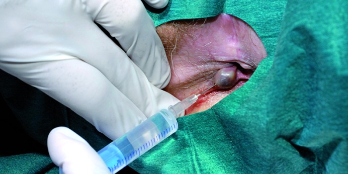 Lokaal verdoven bij getromboseerde anale randvene