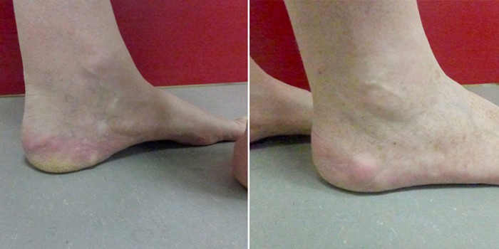 Piëzogene pedale papels