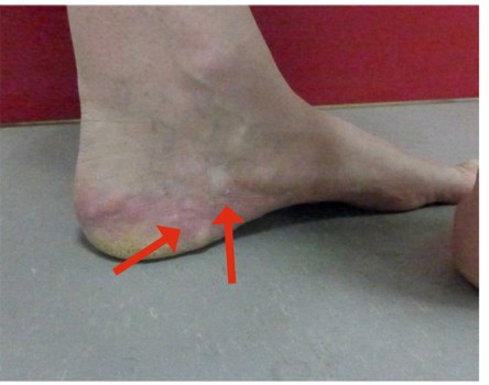 Piëzogene pedale papels