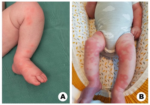 Acuut hemorragisch oedeem