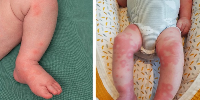 Acuut hemorragisch oedeem