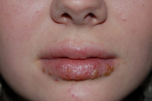 Geïmpetiginiseerd liplikeczeem