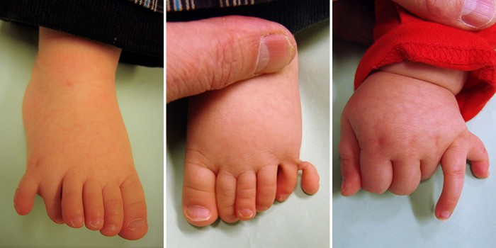 Polydactylie