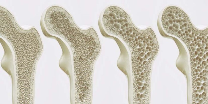Osteoperose