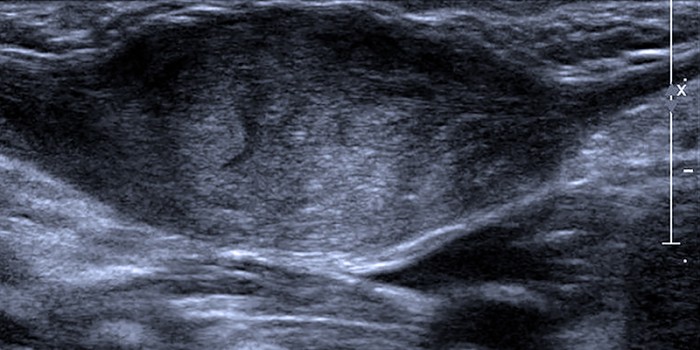 Fibromatosis colli echo