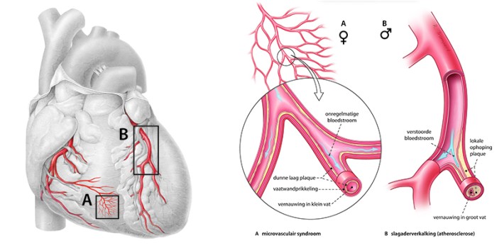 Microvasculair syndroom