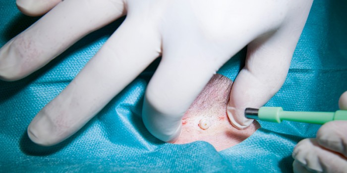 Verwijdering met biopteur