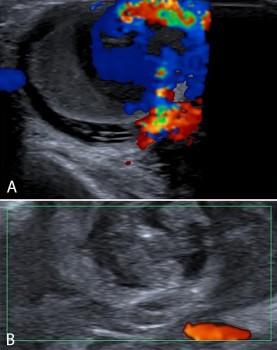 Echografie aneurysma spurium