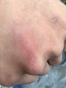 Een slangenbeet, 1 mm groot met omringend marmering en erytheem