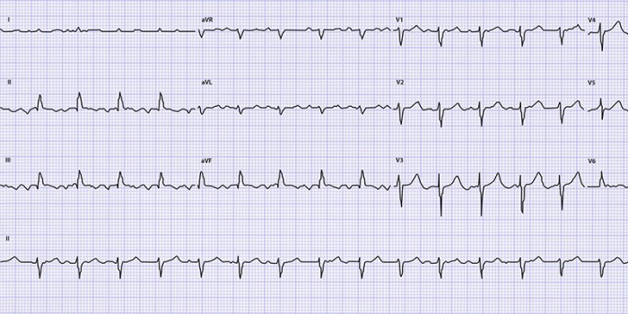 Ecg Hartkloppingen 2