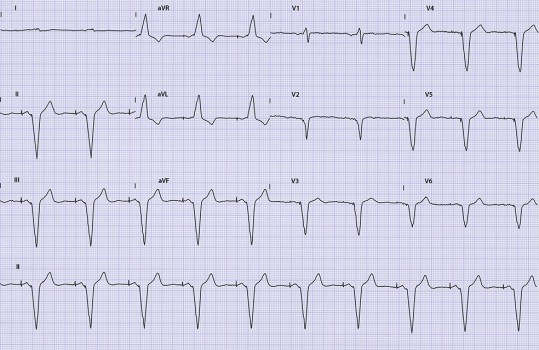 Ecg-casus 'een raadsel'
