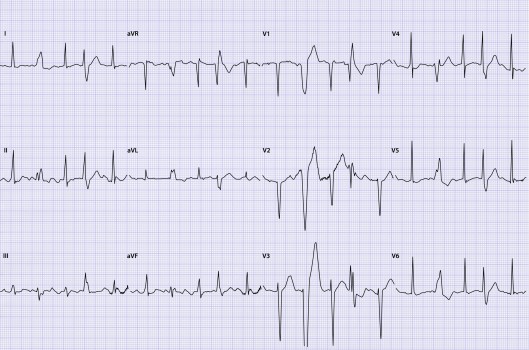 Ecg-casus 1911