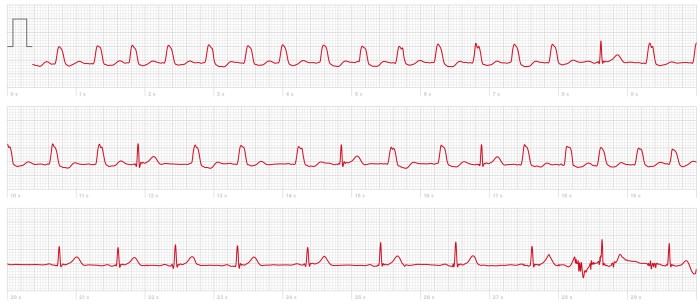 Ecg-casus Smartwatch