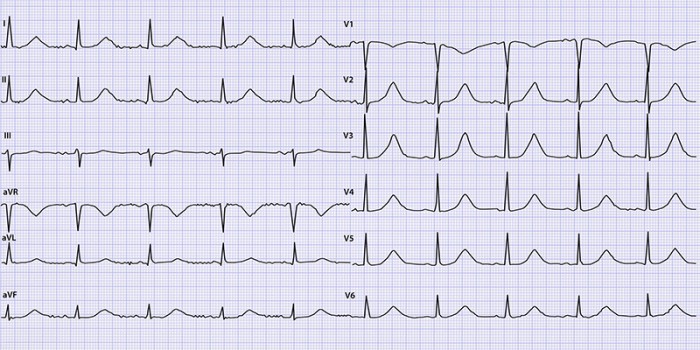 Ecg-casus 'Plotse dood in de familie'