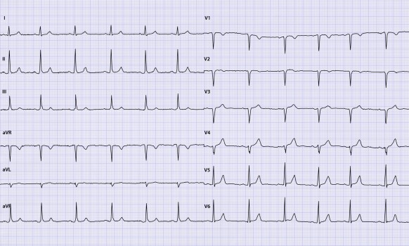 Ecg-casus Schouderpijn
