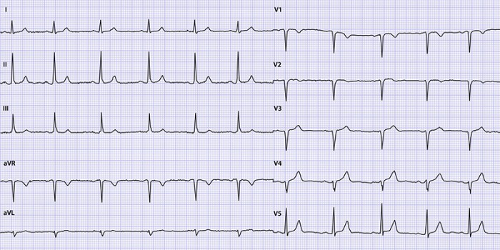Ecg-cas Schouderpijn