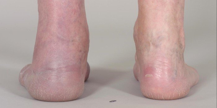 Blauwrode verkleuring