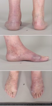 Blauwrode verkleuring figuur