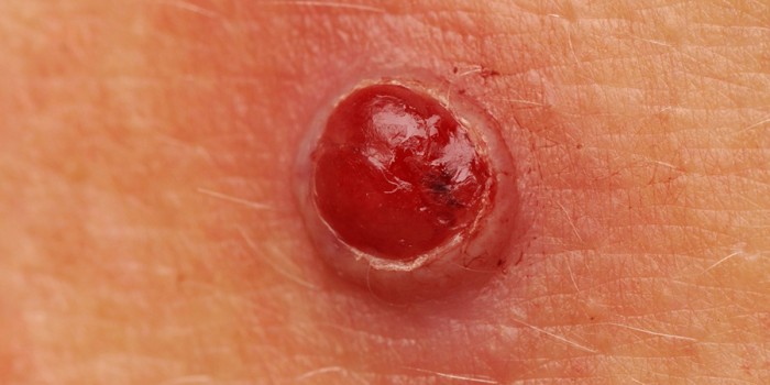 granuloma pyogenicum