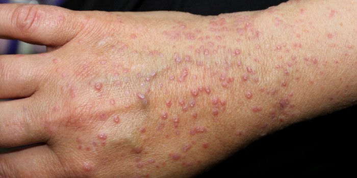 Lichen planus
