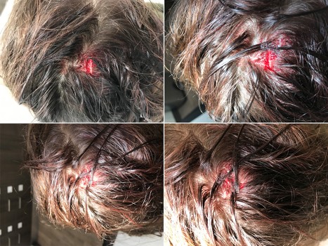 Hair Apposition Technique