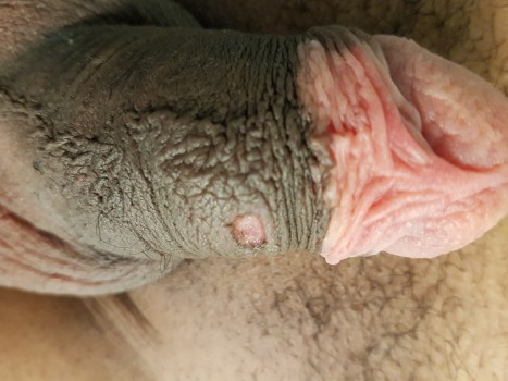 Harde sjanker (ulcus durum,) pijnloze zweer bij primaire syfilis.