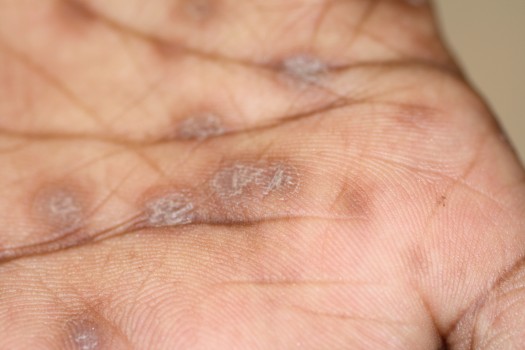 Exantheem op de handpalmen bij secundaire syfilis